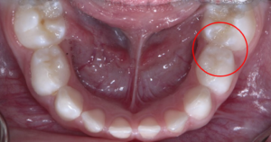 Fig 1: The teeth in the red circle appear healthy and unaffected to the naked eye