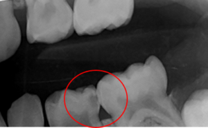 Fig 2: Radiographic image o fthe same teeth clearly shows the decay in between the two teethh